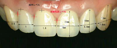 平均的な歯冠長
