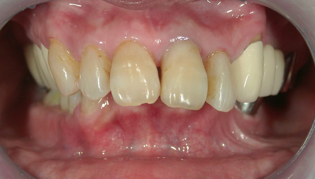 1/2.0 , Dental5 , LR