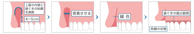 粘膜切除術